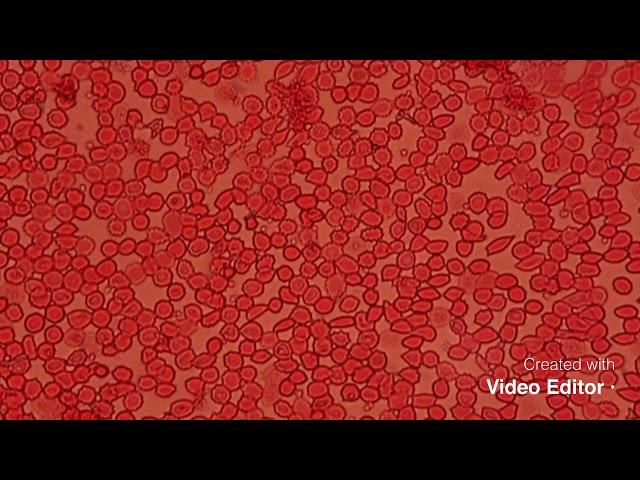 Overview of Fetomaternal hemorrhage Test (Kleihauer Bekte) acid elution