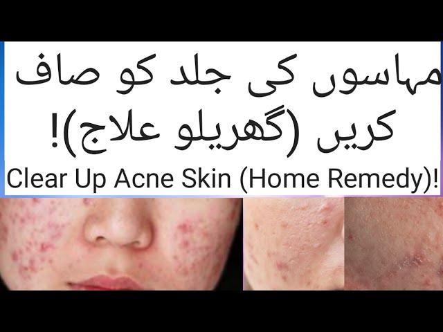 (مہاسوں کی جلد کو صاف کریں (گھریلو علاج)!) Clear Up Acne Skin (Home Remedy)! | #YoutTubeShorts |