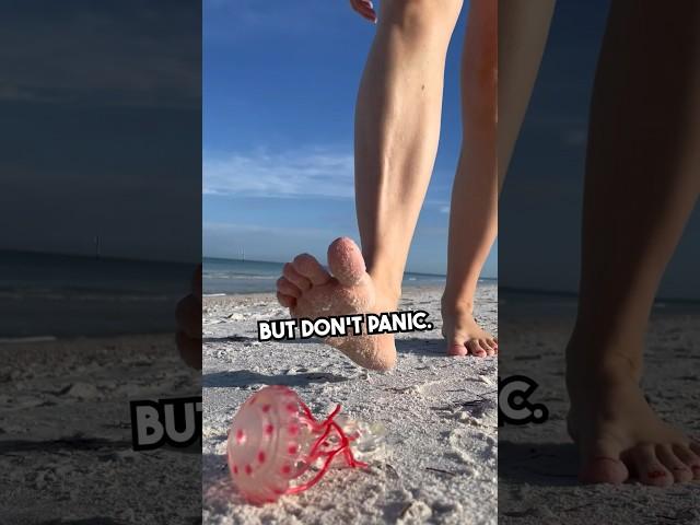 Stung by a jellyfish? Try this… #beach #summer #survival