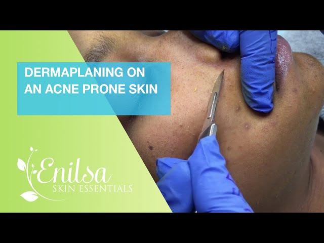 Dermaplaning On An Acne Prone Skin