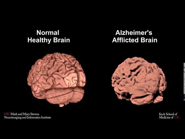 Normal and Alzheimer's brains dataset comparison.