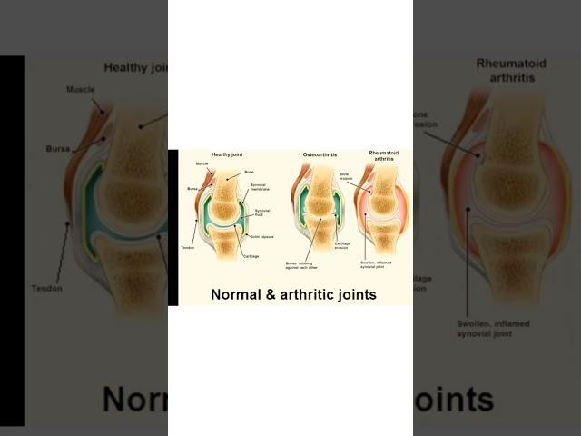Arthritis [General Information for Patient Awareness]  #shorts