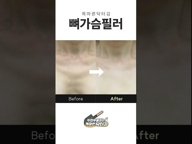 뼈가슴필러 가슴필러 전후비교 #shorts