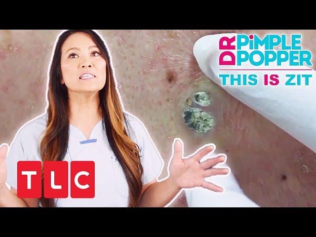 This is Zit: Ein riesiger Mitesser | Dr. Pimple Popper | TLC Deutschland