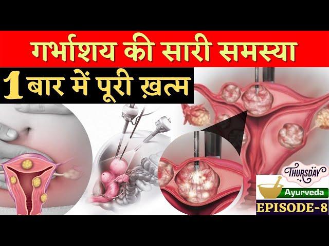 गर्भाशय की गाँठ (FIBROID) 1 बार में पूरी ख़त्म - Kaise ?? Ayurvedic Treatment of Fibroids in Hindi