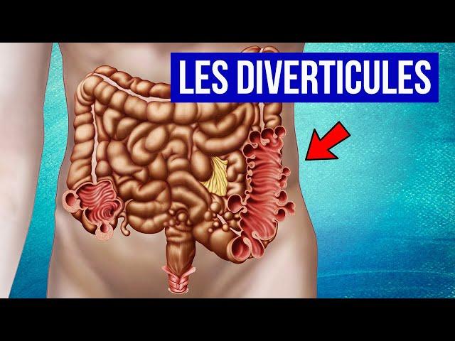 DIVERTICULES ET DIVERTICULITE : Explication et Traitements