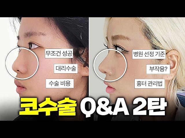 [코수술 Q&A 2탄] 코수술 6개월차 (무조건 성공, 대리수술 썰, 코수술 전후, 부작용, 염증, 병원 선정 기준 등등)