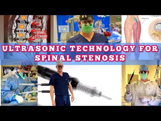 𝐔𝐥𝐭𝐫𝐚𝐬𝐨𝐧𝐢𝐜 Spine Surgery 𝐓𝐞𝐜𝐡𝐧𝐨𝐥𝐨𝐠𝐲 for Spinal Stenosis! 