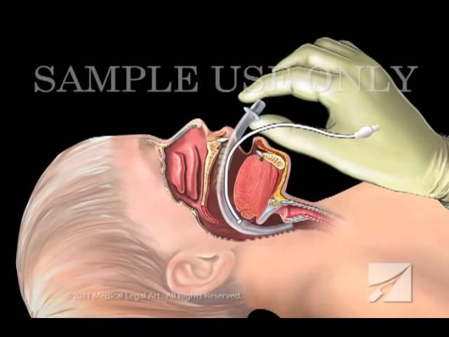 Tracheal Intubation: Laryngeal Mask Airway Device