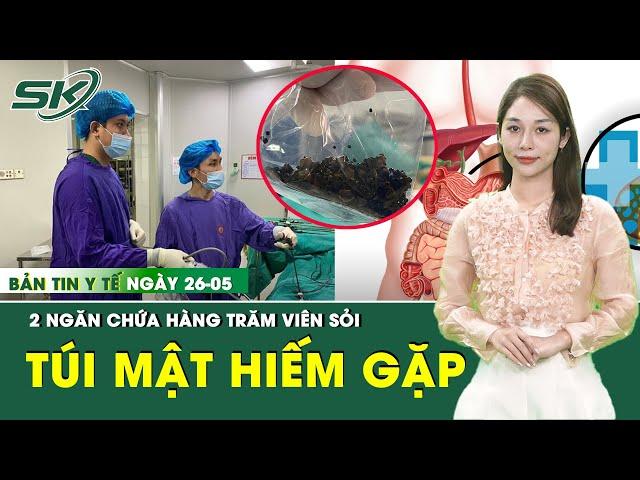Bản Tin Y Tế 26/5: Người phụ nữ có túi mật 2 ngăn chứa hàng trăm viên sỏi | SKĐS