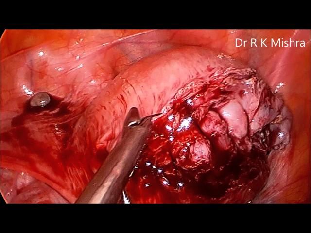 Laparoscopic Myomectomy for Intramural Myoma