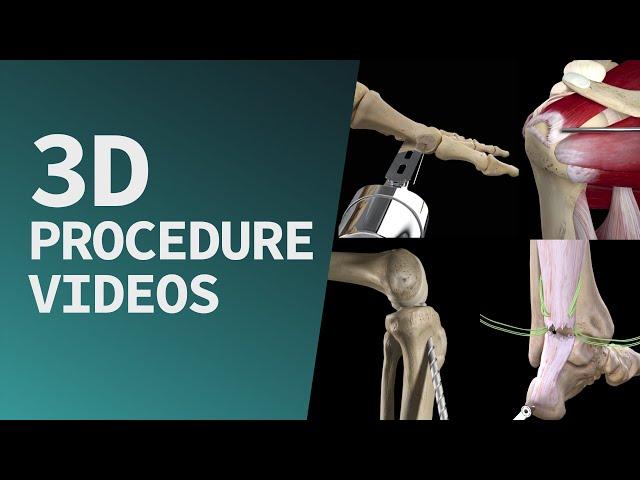 Start exploring a suite of 3D procedure videos in Complete Anatomy