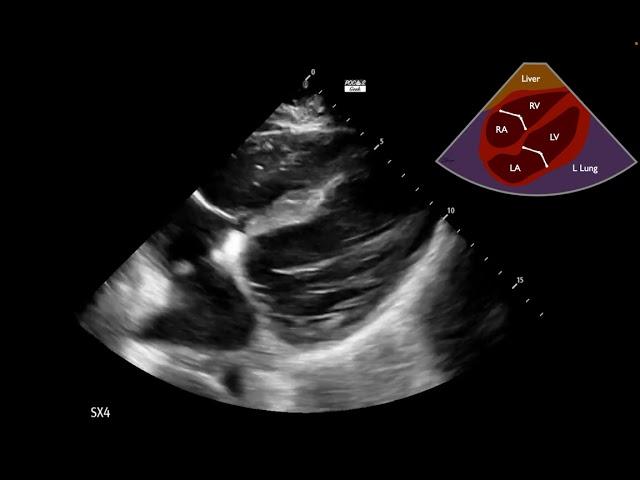 Cardiogenic Shock Case 2:  Part 1 - Interpretation Challenge