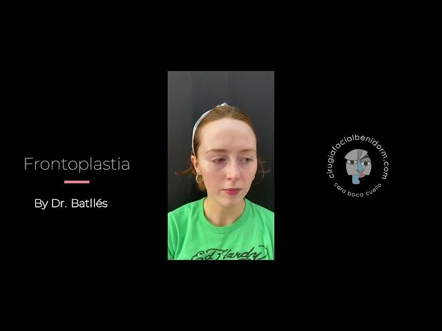 FRONTOPLASTIA BY DR  BATLLÉS