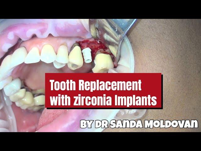 Why Ceramic Implants Are the Future of Dentistry