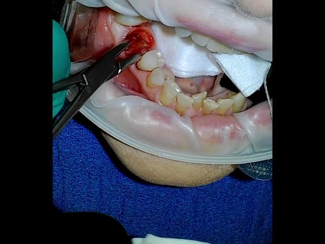 Surgical Extraction with Root Tip Removal and Gelfoam Placement Lower Molar