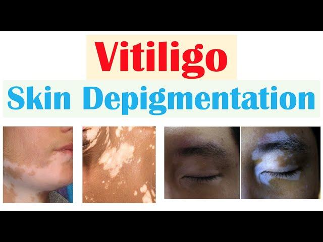 Vitiligo (Skin Depigmentation) | Pathophysiology, Signs and Symptoms, Diagnosis, Treatment