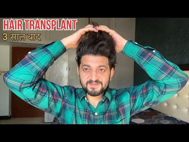 My Hair Transplant Results After 3 Years | My Hair Transplant Cost, Medicine, Care, Experience |