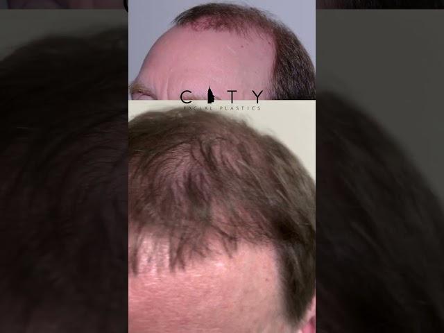 FUE Hair Transplant Results (2,500 Grafts)