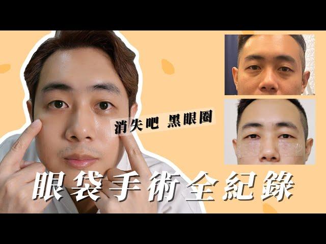 【眼袋淚溝手術】心得分享全紀錄、終於消失的黑眼圈 ! 非常有感 、VLOG | Andy店長