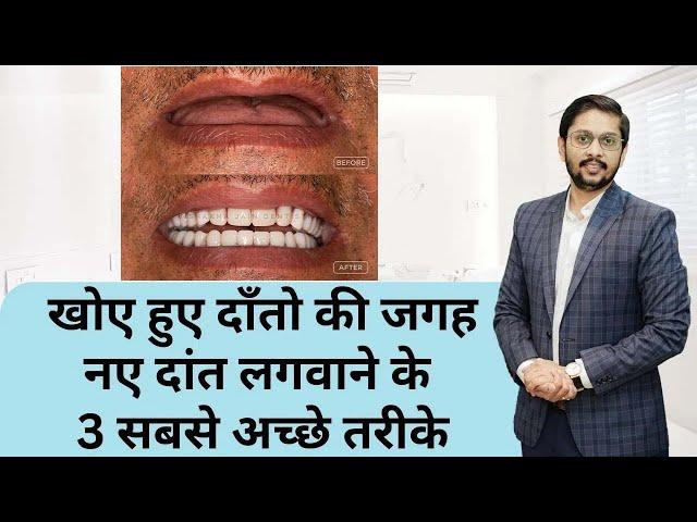 खोए हुए दाँत लगवाने के 3 प्रकार और खर्च ! Three Teeth replacement options and cost ! By Dr Ankit