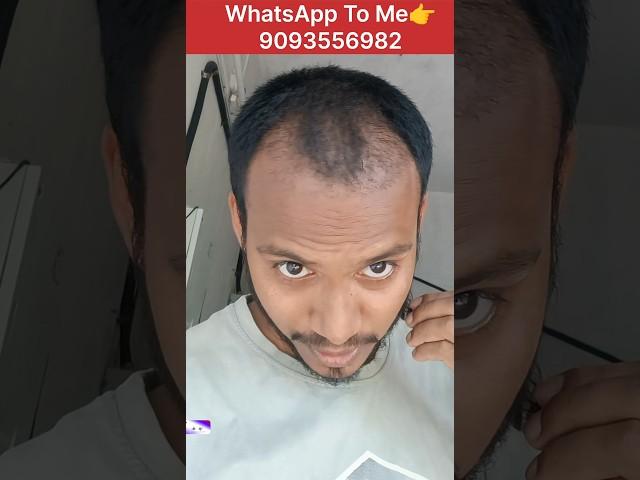 BOLD TO HAIR JOURNEY ️ #hairtransplant