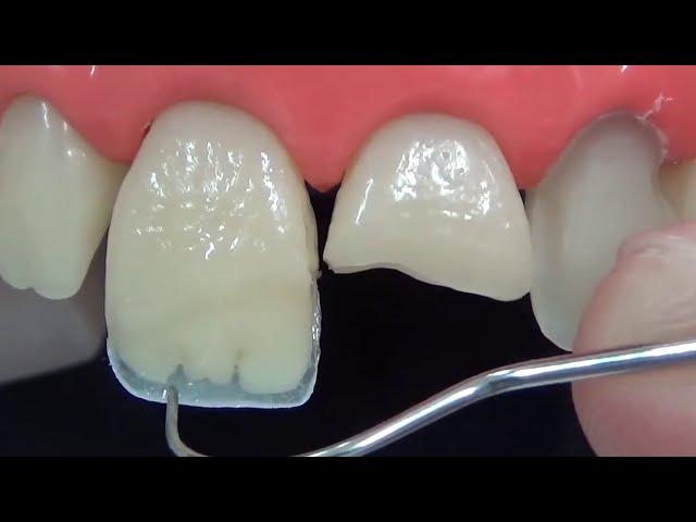 Direct restoration of the front tooth in 3 minutes | TIME LAPSE . Anterior tooth restoration