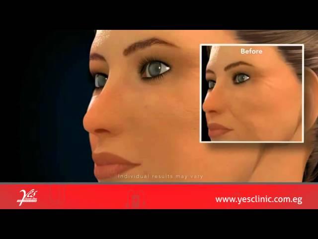 Radiesse Volumizing Filler Animation   Cosmetic Enhancement