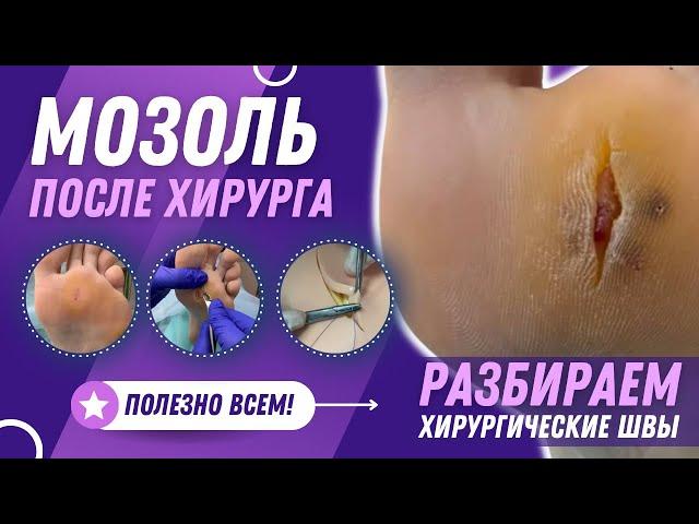 Мозоль после хирурга. Разбираем хирургические швы. Полезно всем! #хирург #разбор #медицина