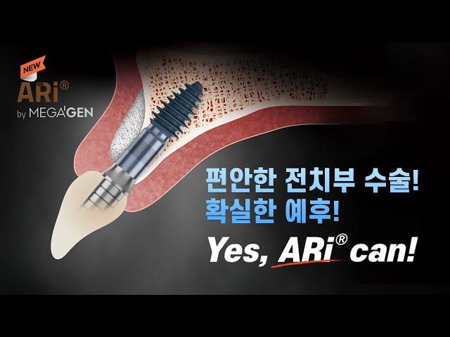 전치부 솔루션, 14년 만의 신제품 'ARi'