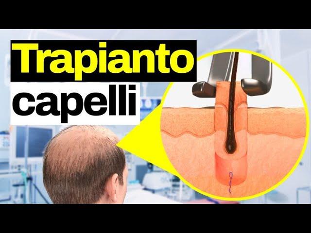 Si sradicano i bulbi con una sorta di levatorsoli - il TRAPIANTO DEI CAPELLI