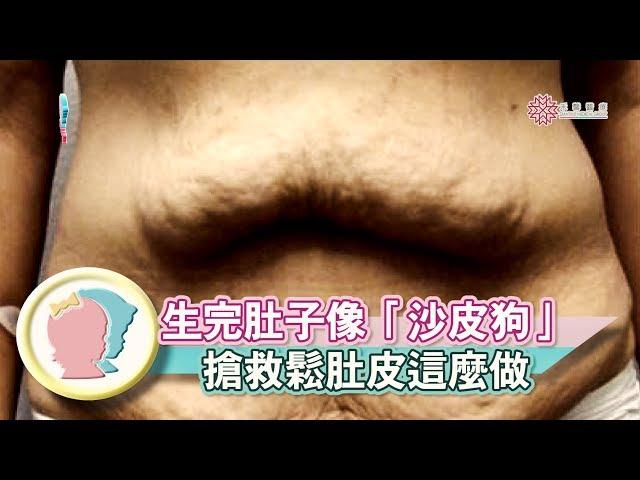 《生完肚子像「沙皮狗」  搶救鬆肚皮這麼做》【專家幫解答】《產後修護》│寶貝幫TV