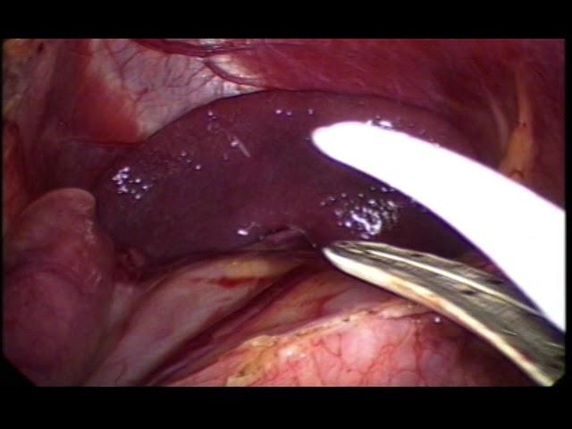 lap fundoplication by prof Wael Tobar MD