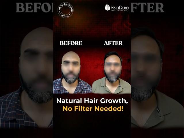 Watch Hair Come Back | Before After | Dr. Jangid
