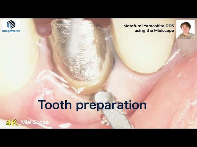Mielscope - Tooth preparation