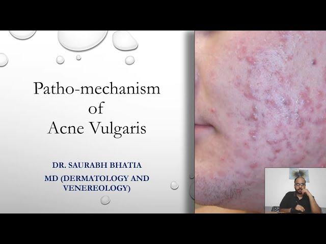 Patho-mechanism of Acne Vulgaris