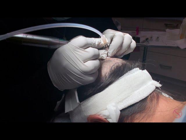 SmartGraft Hair Transplant at The Dermatology Laser and Vein Center