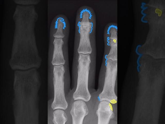 Psoriatic arthritis at a glance