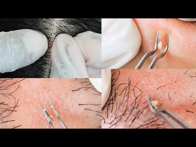 Super-zoomed Face Extractions & Picking Ingrown Hair | Scalp Nitpicking Whiteheads ‍️| ASMR