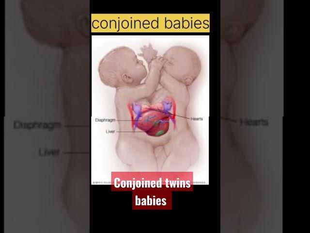 conjoined twins babies