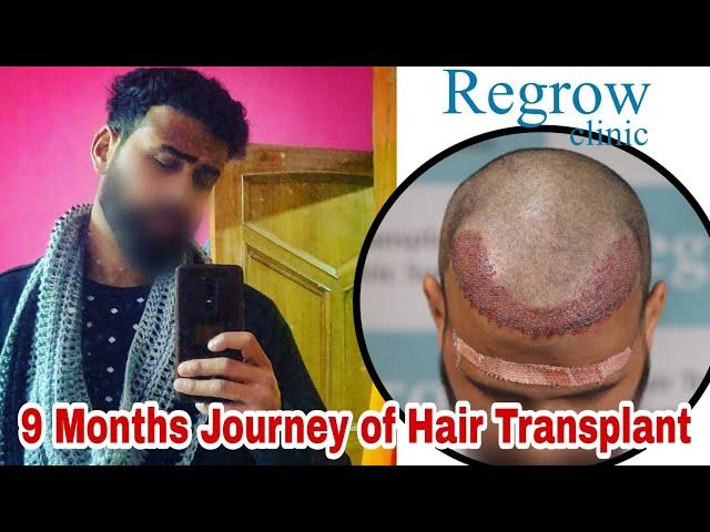 Best Hair Transplant Result 2021 || NW Grade III || 2,812 Grafts ||  @Regrow Clinic ​