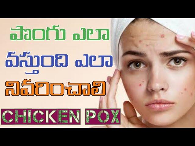 Home remedies for chicken pox in telugu - Chickenpox in telugu - Varicella - ammoru- atalamma- pongu