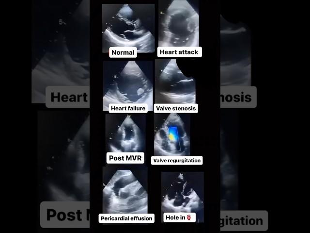 Echocardiogram NORMAL vs ABNORMAL! #radiology #cardiology