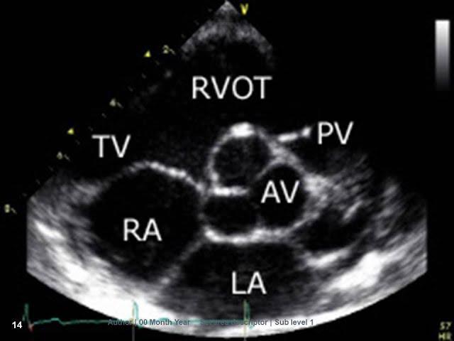 Normal echocardiography, Dr. Wael Elkilany