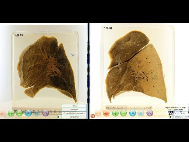 Lobar pneumonia vs Bronchopneumonia