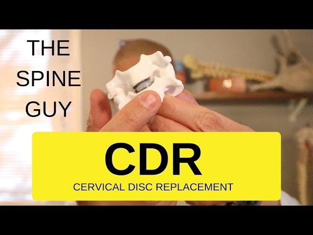 CERVICAL STENOSIS RADICULOPATHY - PART 6 - CERVICAL DISC REPLACEMENT