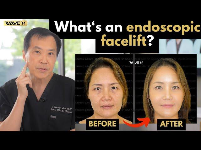 What's an Endoscopic Facelift?| Wave Plastic Surgery