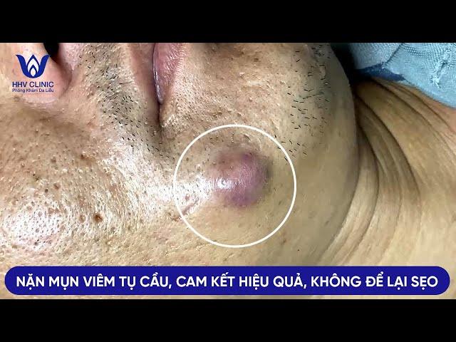 ĐIỀU TRỊ MỤN VIÊM TỤ CẦU, HIỆU QUẢ SAU 1 BUỔI, KHÔNG ĐỂ LẠI SẸO TẠI PHÒNG KHÁM DA LIỄU HHV CLINIC.