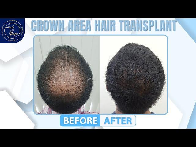 Crown Hair Transplant || Case Study and Result || Best Hair Transplant In India