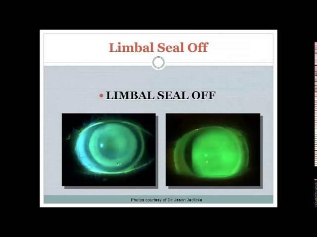 Get All Of Your Scleral Lens Questions Answered